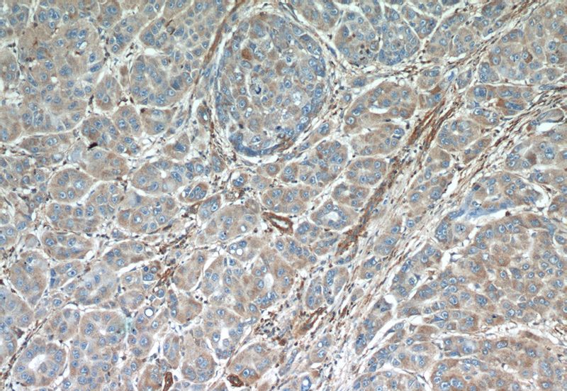 Immunohistochemical of paraffin-embedded human liver cancer using Catalog No:108094(ANXA3 antibody) at dilution of 1:50 (under 10x lens)