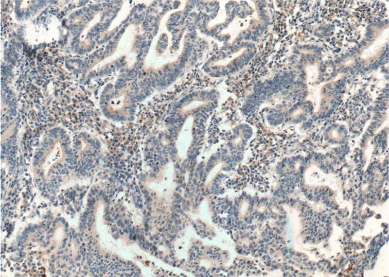 Immunohistochemistry of paraffin-embedded human endometrial cancer tissue slide using Catalog No:114758(RNF38 Antibody) at dilution of 1:200 (under 10x lens). heat mediated antigen retrieved with Tris-EDTA buffer(pH9).