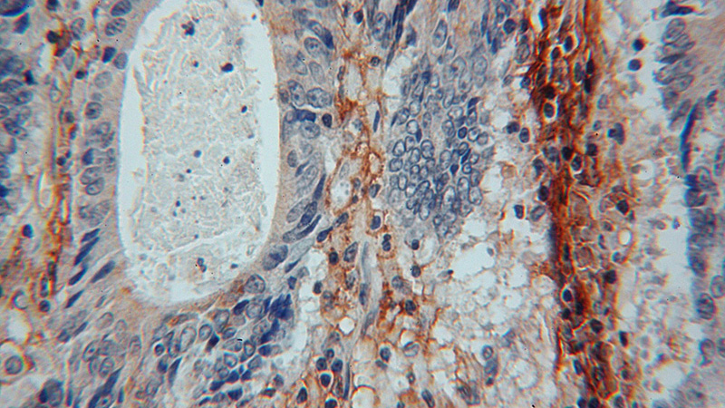 Immunohistochemical of paraffin-embedded human colon cancer using Catalog No:111589(ICAM-1 antibody) at dilution of 1:50 (under 40x lens)