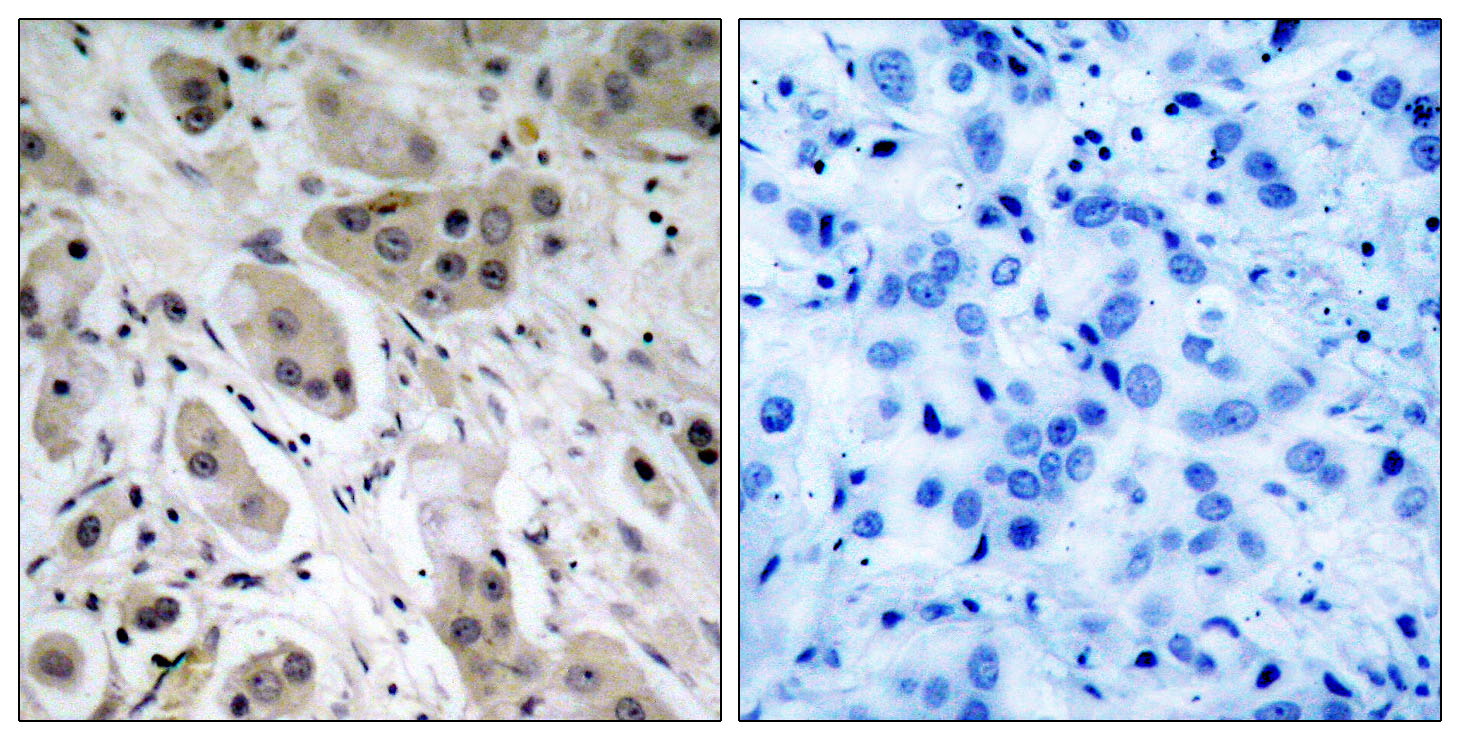 Immunohistochemical analysis of paraffin-embedded human breast carcinoma tissue using Akt (Phospho-Ser473) Antibody (left) or the same antibody preincubated with blocking peptide (right).