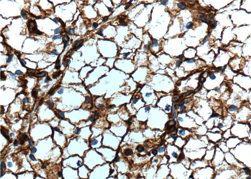 Immunohistochemistry of paraffin-embedded human renal cell carcinoma tissue slide using Catalog No:107540(Vimentin Antibody) at dilution of 1:500 (under 40x lens). heat mediated antigen retrieved with Tris-EDTA buffer(pH9).