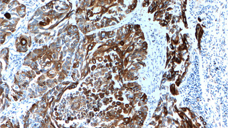 Immunohistochemistry of paraffin-embedded human lung cancer tissue slide using Catalog No:109807(KRT6A Antibody) at dilution of 1:200 (under 10x lens).