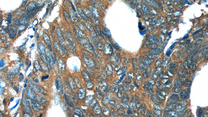 Immunohistochemistry of paraffin-embedded human colon cancer tissue slide using Catalog No:114683(REG4 Antibody) at dilution of 1:200 (under 40x lens).