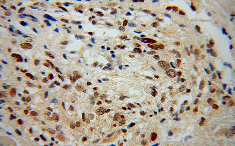 Immunohistochemical of paraffin-embedded human gliomas using Catalog No:108134(ANAPC2 antibody) at dilution of 1:100 (under 40x lens)