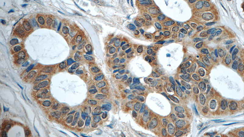 Immunohistochemistry of paraffin-embedded human breast cancer tissue slide using Catalog No:107629(TNF-a Antibody) at dilution of 1:50 (under 40x lens)