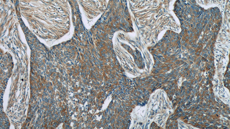 Immunohistochemistry of paraffin-embedded human skin cancer tissue slide using Catalog No:112835(MRPL53 Antibody) at dilution of 1:50 (under 10x lens)