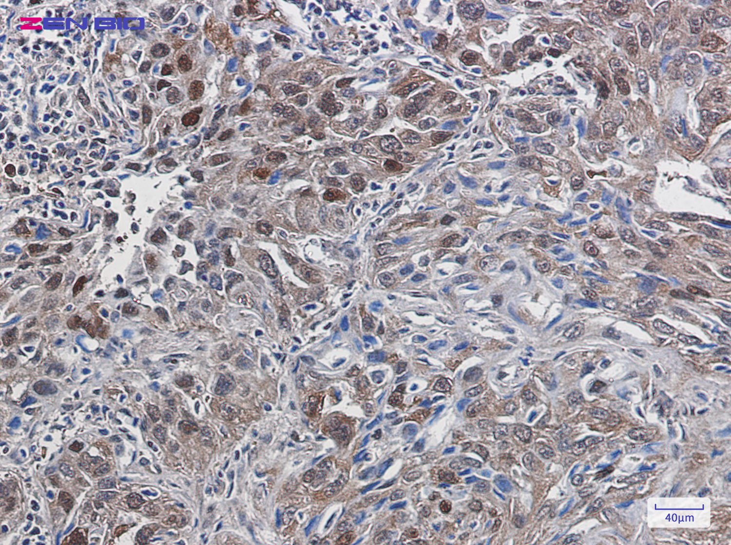 Immunohistochemistry of TXNRD1 in paraffin-embedded Human lung cancer tissue using TXNRD1 Rabbit pAb at dilution 1/20