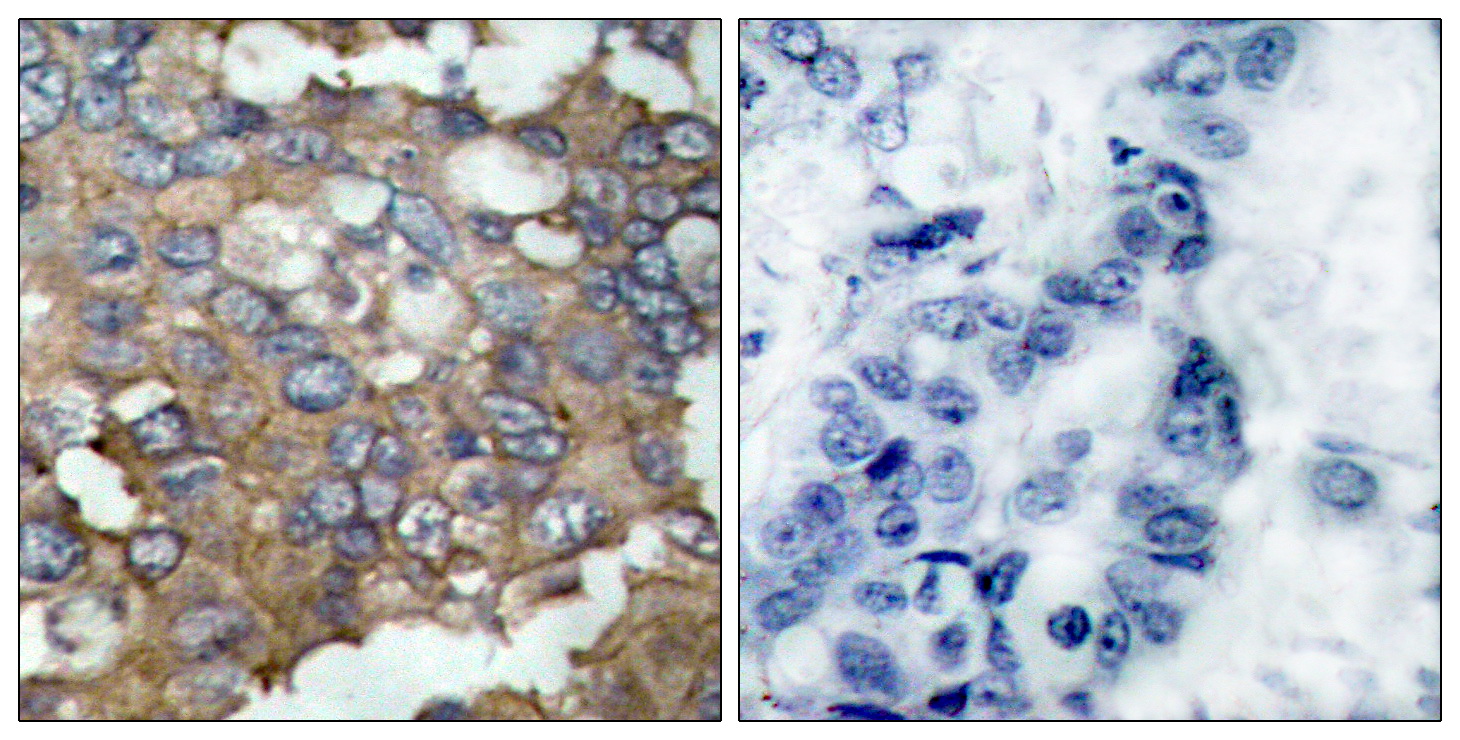 Immunohistochemical analysis of paraffin-embedded human breast carcinoma tissue using Src (Ab-529) Antibody  (left) or the same antibody preincubated with blocking peptide (right).