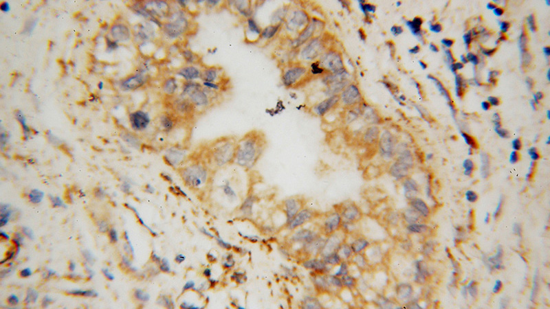Immunohistochemical of paraffin-embedded human pancreas cancer using Catalog No:115161(SFXN3 antibody) at dilution of 1:100 (under 40x lens)