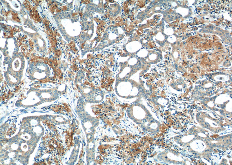 Immunohistochemistry of paraffin-embedded human lung cancer tissue slide using Catalog No:116836(WNT5A-B Antibody) at dilution of 1:50 (under 10x lens)
