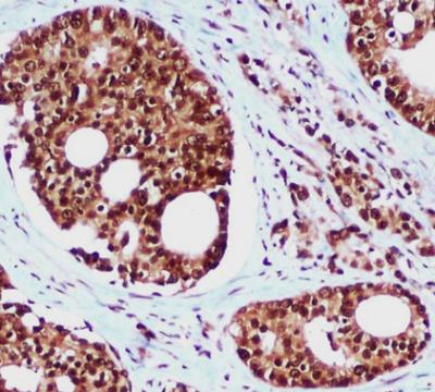 Immunohistochemical analysis of paraffin-embedded Prostate Cancer using hHR23b mouse mAb (1/100 dilution).Antigen retrieval was performed by pressure cooking in citrate buffer (pH 6.0).