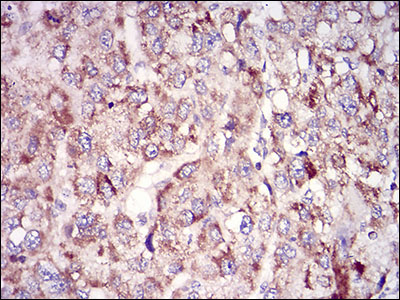 Fig4: Immunohistochemical analysis of paraffin-embedded human liver cancer tissue using anti-TUBE1 antibody. Counter stained with hematoxylin.