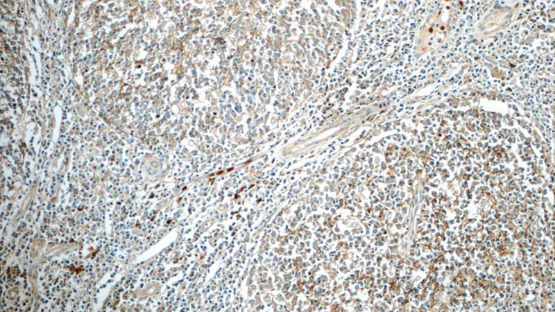 Immunohistochemistry of paraffin-embedded human tonsillitis tissue slide using Catalog No:109042(CD11B Antibody) at dilution of 1:50 (under 10x lens)
