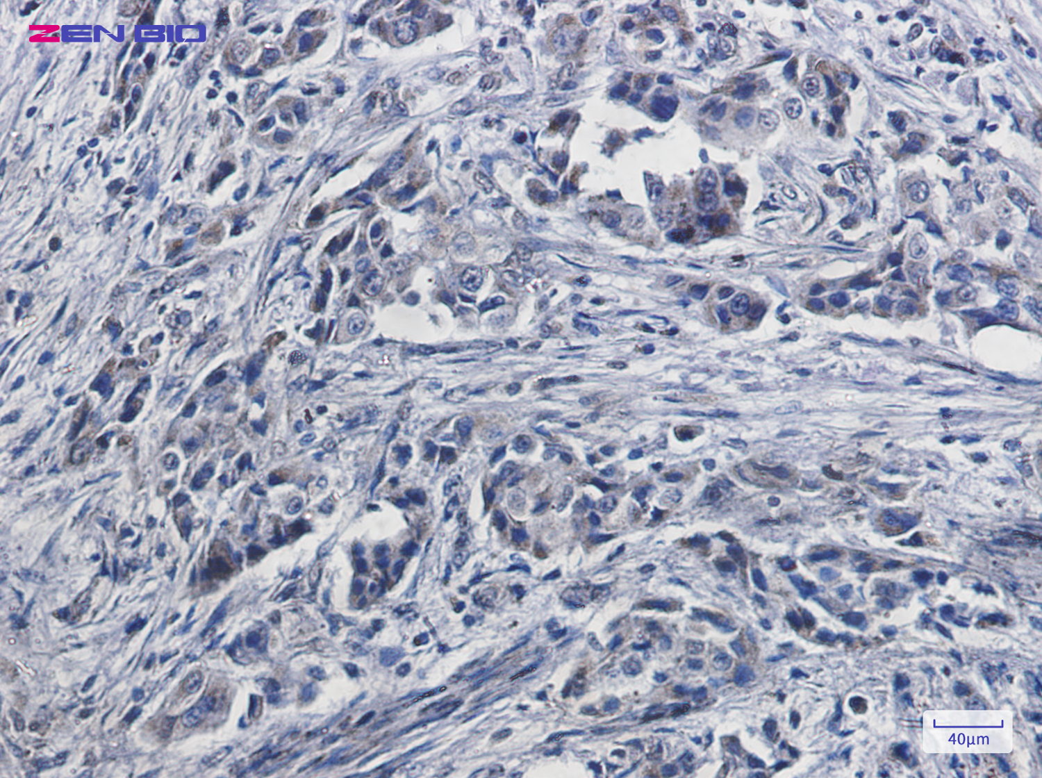 Immunohistochemistry of NDUFB11 in paraffin-embedded Human lung cancer tissue using NDUFB11 Rabbit pAb at dilution 1/50