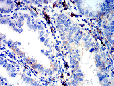 Fig4: Immunohistochemical analysis of paraffin-embedded human endometrial cancer tissue using anti-IGLC2 antibody. Counter stained with hematoxylin.
