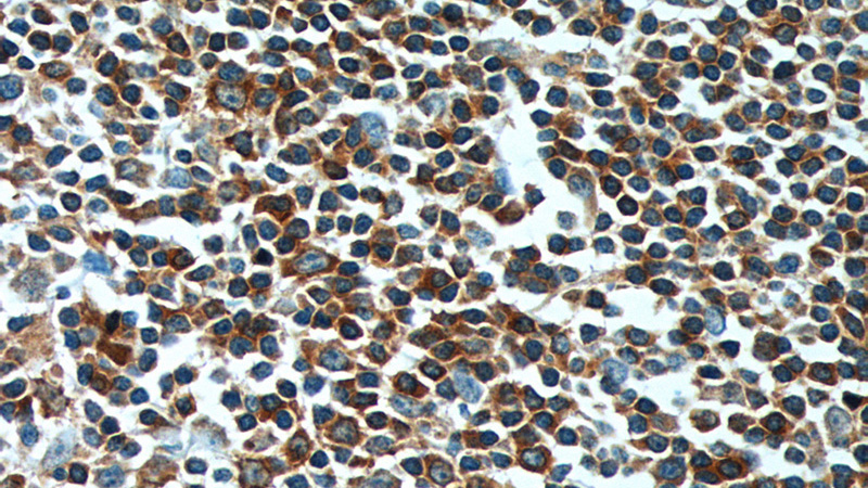 Immunohistochemistry of paraffin-embedded human tonsillitis tissue slide using Catalog No:108265(ARHGAP25 Antibody) at dilution of 1:200 (under 40x lens)