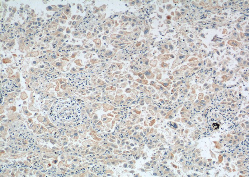 Immunohistochemistry of paraffin-embedded human lung cancer tissue slide using Catalog No:112488(SERPINB5 Antibody) at dilution of 1:200 (under 10x lens). heat mediated antigen retrieved with Tris-EDTA buffer(pH9).