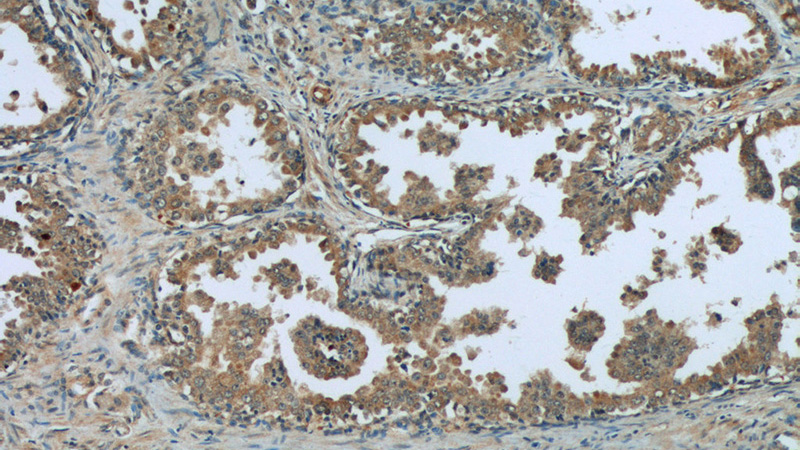 Immunohistochemistry of paraffin-embedded human prostate cancer tissue slide using Catalog No:112453(MAGEH1 Antibody) at dilution of 1:50 (under 10x lens)