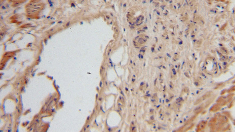 Immunohistochemical of paraffin-embedded human prostate cancer using Catalog No:112365(MACF1 antibody) at dilution of 1:100 (under 10x lens)