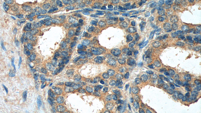 Immunohistochemistry of paraffin-embedded human prostate hyperplasia tissue slide using Catalog No:111107(GPR120 Antibody) at dilution of 1:100 (under 40x lens).