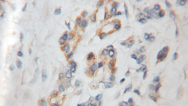 Immunohistochemical of paraffin-embedded human pancreas cancer using Catalog No:114311(PTP4A1 antibody) at dilution of 1:50 (under 10x lens)