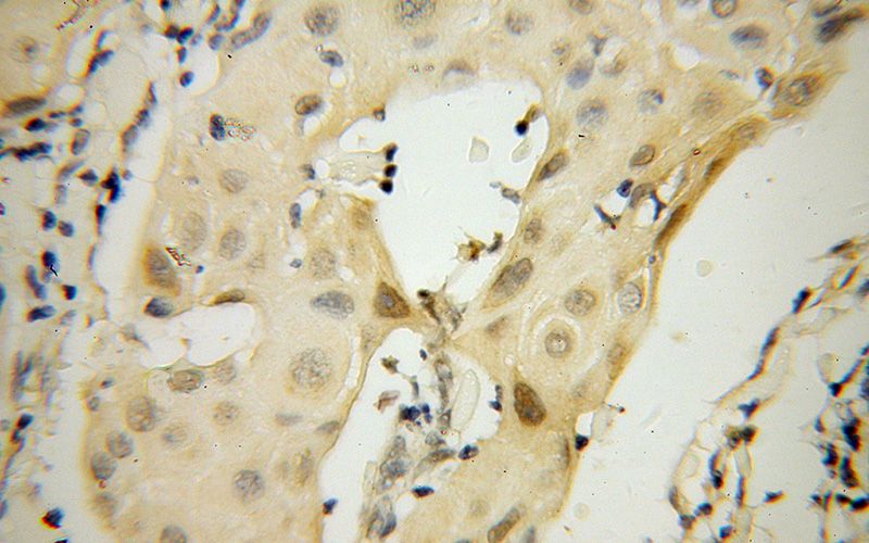 Immunohistochemical of paraffin-embedded human cervical cancer using Catalog No:117052(ZHX1 antibody) at dilution of 1:100 (under 40x lens)