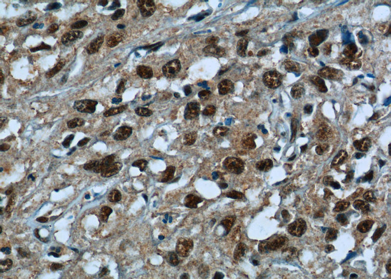 Immunohistochemistry of paraffin-embedded human cervical cancer tissue slide using Catalog No:115465(SNRPG Antibody) at dilution of 1:50 (under 40x lens)