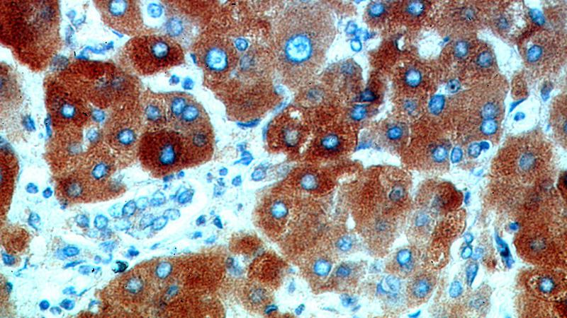 Immunohistochemical of paraffin-embedded human hepatocirrhosis using Catalog No:117341(TF antibody) at dilution of 1:50 (under 40x lens)