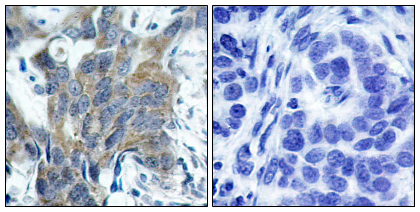 Immunohistochemical analysis of paraffin-embedded human breast carcinoma tissue using u03b2-Catenin (Phospho-Ser33) Antibody  (left) or the same antibody preincubated with blocking peptide (right).