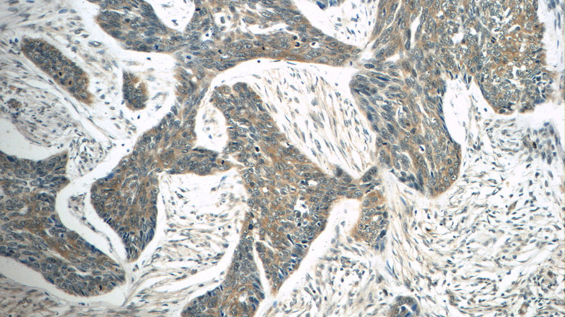 Immunohistochemistry of paraffin-embedded human skin cancer tissue slide using Catalog No:116275(TMPRSS3 Antibody) at dilution of 1:50 (under 10x lens)