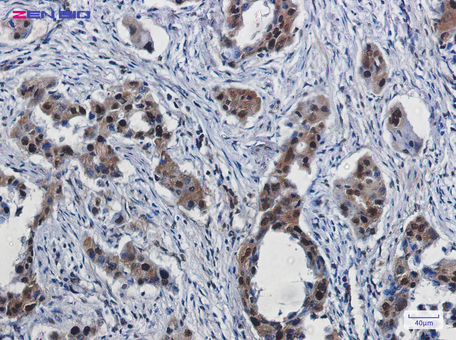 Immunohistochemistry of ROC1 in paraffin-embedded Human lung cancer tissue using ROC1 Rabbit pAb at dilution 1/50