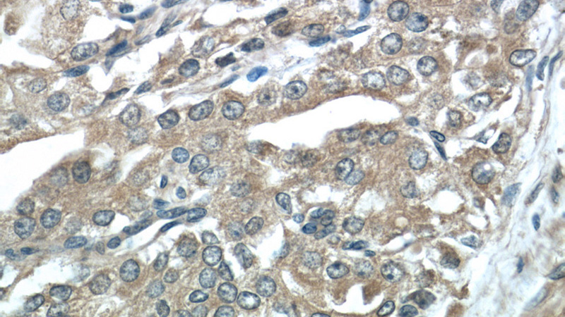 Immunohistochemistry of paraffin-embedded human prostate cancer tissue slide using (KLK3,PSA Antibody) at dilution of 1:50 (under 40x lens)