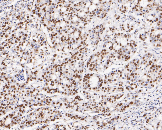 Fig8:; Immunohistochemical analysis of paraffin-embedded human stomach carcinoma tissue using anti-GATAD2A antibody. The section was pre-treated using heat mediated antigen retrieval with sodium citrate buffer (pH 6.0) for 20 minutes. The tissues were blocked in 5% BSA for 30 minutes at room temperature, washed with ddH; 2; O and PBS, and then probed with the primary antibody ( 1/200) for 30 minutes at room temperature. The detection was performed using an HRP conjugated compact polymer system. DAB was used as the chromogen. Tissues were counterstained with hematoxylin and mounted with DPX.