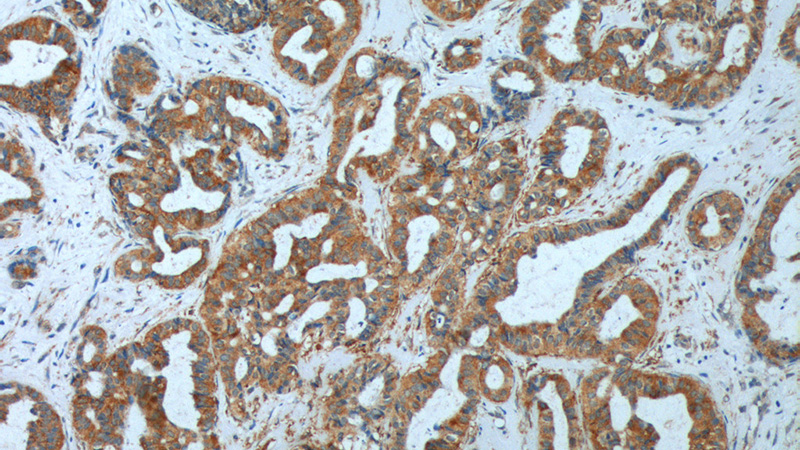 Immunohistochemistry of paraffin-embedded human breast cancer tissue slide using Catalog No:115596(SRPK1 Antibody) at dilution of 1:200 (under 10x lens).