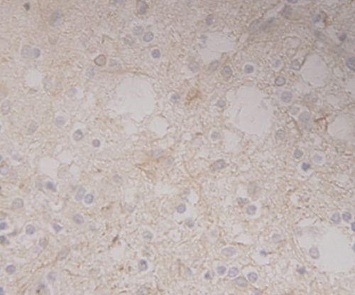 Fig5: Immunohistochemical analysis of paraffin-embedded human glioma tissue using anti-GRAMD1A antibody. Counter stained with hematoxylin.