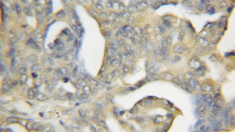 Immunohistochemical of paraffin-embedded human ovary tumor using Catalog No:108820(CAPS2 antibody) at dilution of 1:50 (under 10x lens)