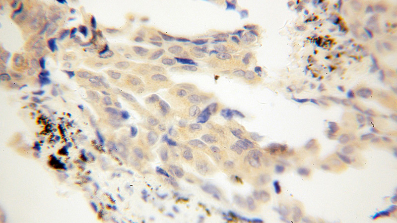 Immunohistochemical of paraffin-embedded human lung cancer using Catalog No:109301(CHSY1 antibody) at dilution of 1:100 (under 40x lens)
