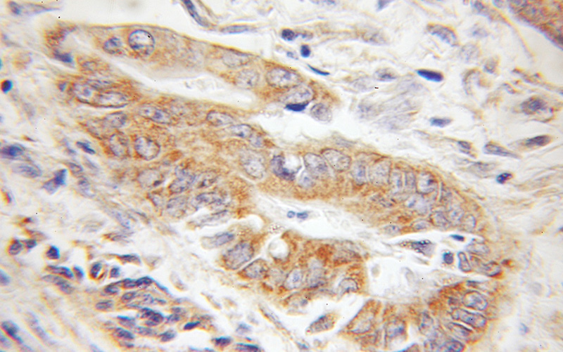 Immunohistochemical of paraffin-embedded human colon cancer using Catalog No:116172(TOMM22 antibody) at dilution of 1:100 (under 10x lens)