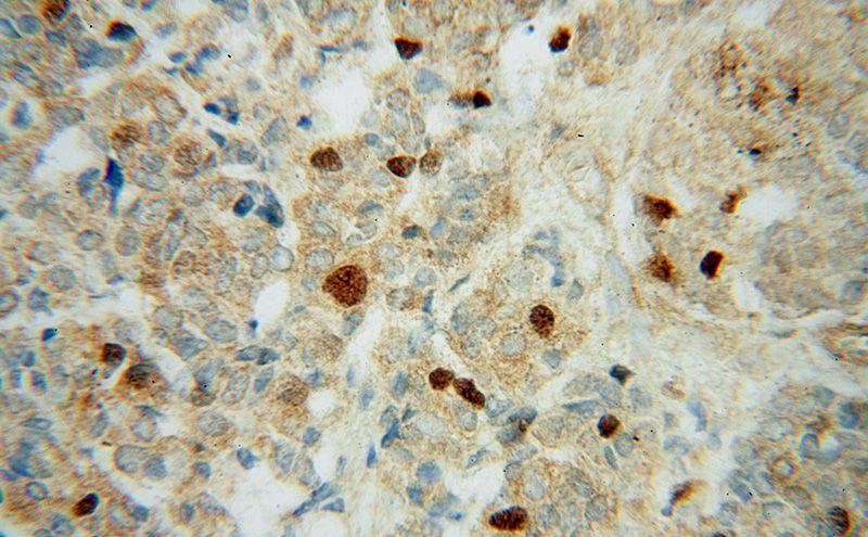 Immunohistochemical of paraffin-embedded human breast cancer using Catalog No:114169(PRC1 antibody) at dilution of 1:50 (under 40x lens)