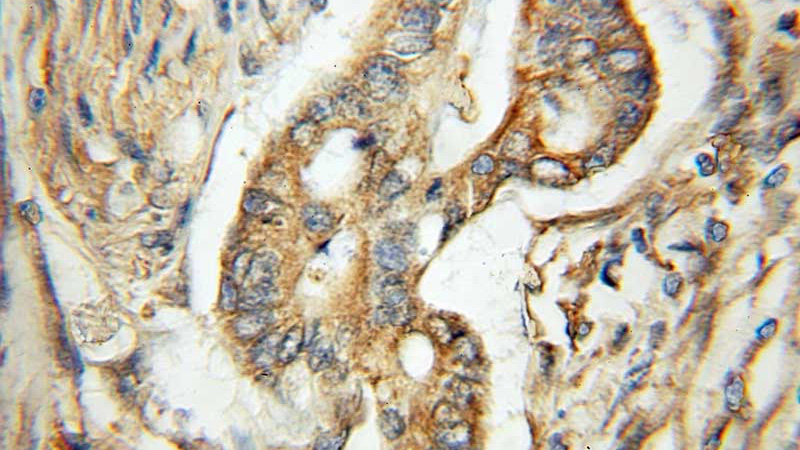 Immunohistochemical of paraffin-embedded human pancreas cancer using Catalog No:110371(ERO1LB antibody) at dilution of 1:50 (under 40x lens)