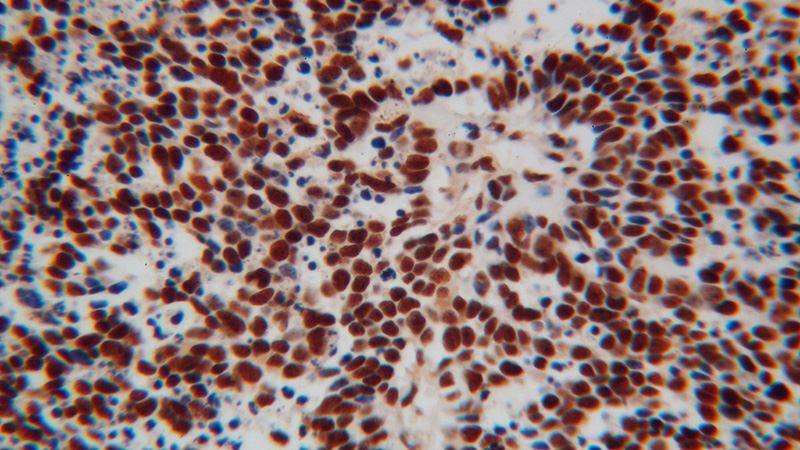 Immunohistochemical of paraffin-embedded human lung cancer using Catalog No:115926(TARDBP antibody) at dilution of 1:100 (under 40x lens)