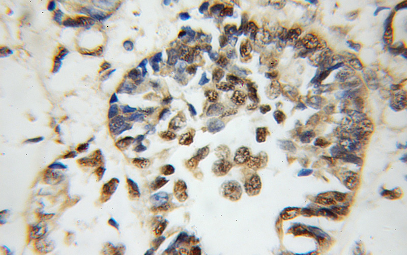 Immunohistochemical of paraffin-embedded human breast cancer using Catalog No:109319(CIRBP antibody) at dilution of 1:100 (under 10x lens)