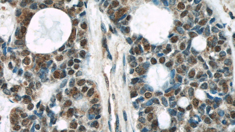 Immunohistochemical of paraffin-embedded human cervical cancer using Catalog No:107568(AKT antibody) at dilution of 1:50 (under 40x lens)