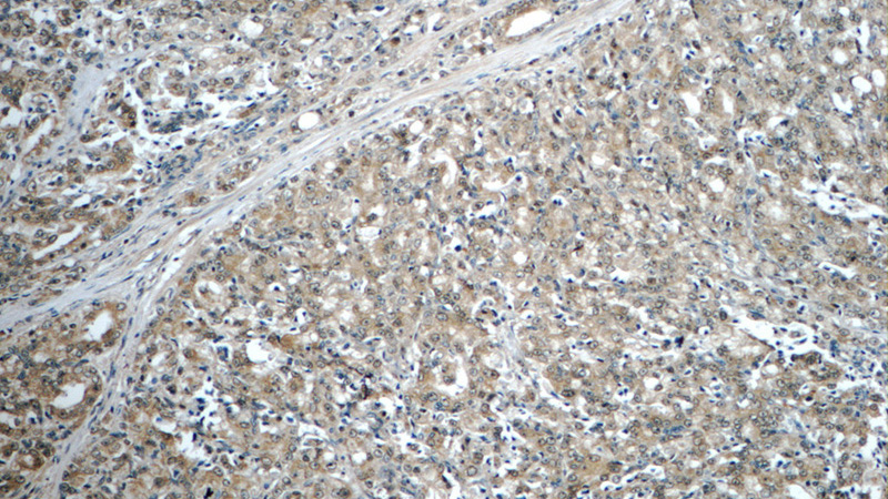 Immunohistochemistry of paraffin-embedded human prostate cancer tissue slide using Catalog No:107995(ACY1 Antibody) at dilution of 1:50 (under 10x lens)