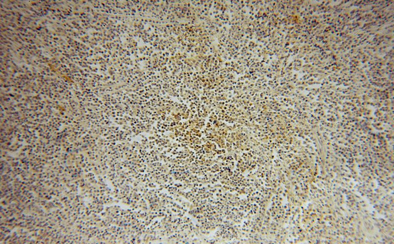 Immunohistochemical of paraffin-embedded human lymphoma using Catalog No:114323(PTPN7 antibody) at dilution of 1:100 (under 10x lens)