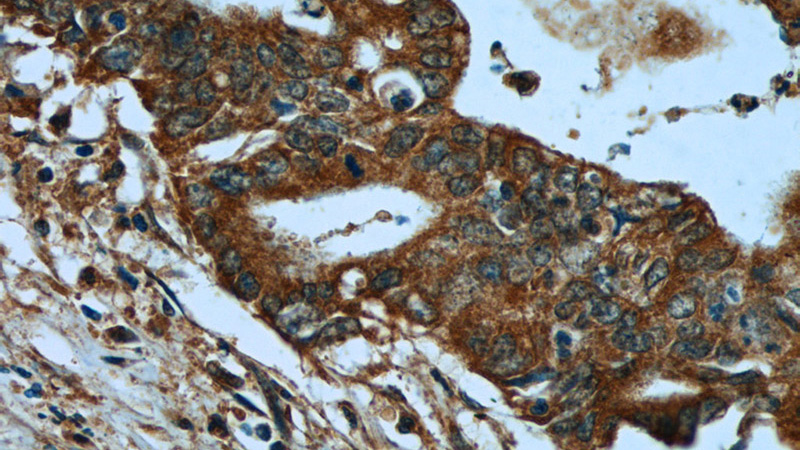 Immunohistochemistry of paraffin-embedded human pancreas cancer tissue slide using Catalog No:116260(PLAT Antibody) at dilution of 1:50 (under 40x lens)