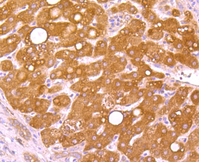 Fig5: Immunohistochemical analysis of paraffin-embedded human liver cancer tissue using anti-WSCD2 antibody. Counter stained with hematoxylin.