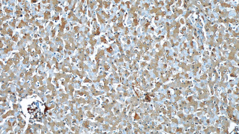 Immunohistochemical of paraffin-embedded human liver using Catalog No:107569(ALB antibody) at dilution of 1:50 (under 10x lens)