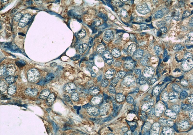 Immunohistochemistry of paraffin-embedded human breast cancer slide using Catalog No:117316(GAPDH Antibody) at dilution of 1:50