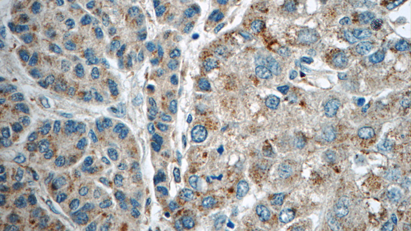 Immunohistochemistry of paraffin-embedded human liver cancer tissue slide using Catalog No:112280(LMF1 Antibody) at dilution of 1:50 (under 40x lens)